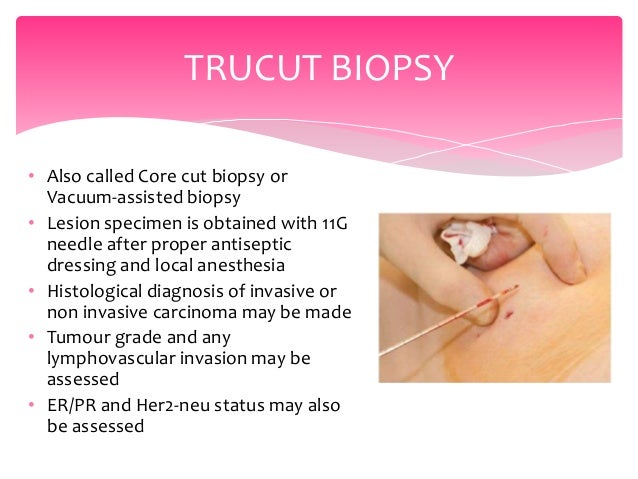 tru cut biopsy breast Tru cut biopsy breast